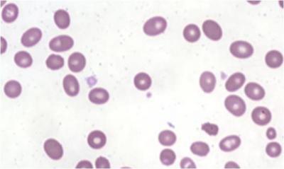 Figure 1: Full blood picture showing severe anaemia with ovalostomatocytes. (Wright’s stain x40)